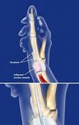 Image result for De Quervain Injection