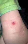 Image result for Popping Molluscum