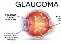 Image result for glaucoma
