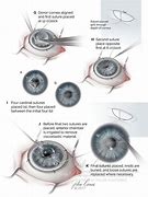 Image result for Keratoplasty Surgery