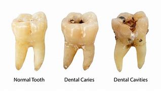 Image result for Cavities Look Like