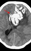 Image result for Oligodendroglioma