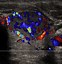 Image result for Solid Thyroid Nodule Ultrasound