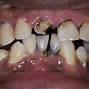 Image result for Rotting Teeth Images