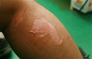 Image result for Dry Peeling Skin