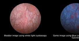 Image result for Bladder Cancer Cystoscopy Images