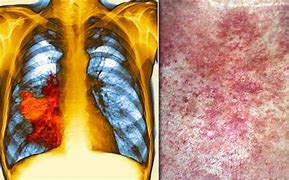 Image result for Lung Adenocarcinoma Skin Lesions