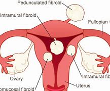Image result for Fibroid Tumors in Stomach