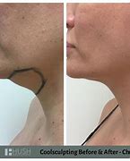 Image result for CoolSculpting Chin Before and After