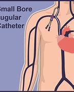 Image result for Central Venous Pressure Catheter