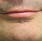 Image result for Types of Warts On Face