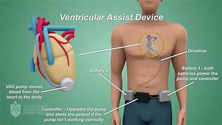 Image result for Ventricular Assist Device