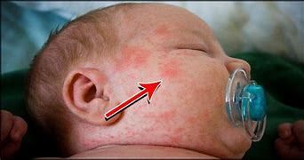Image result for Allergie Baby Symptome