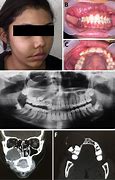 Image result for Calcifying Odontogenic Cyst