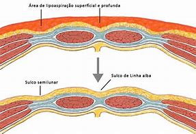 Image result for Liposuccion Con Marcacion Abdominal