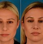 Image result for Rhinoplasty Before and After Photos