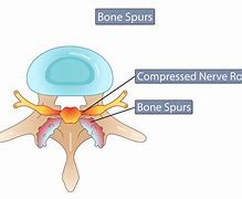 Image result for Corporal Bone Spurs