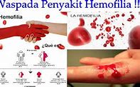 Image result for hemofilia