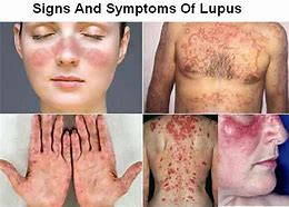 Image result for Loopos Disease