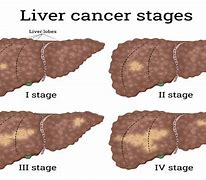 Image result for Liver Tumor