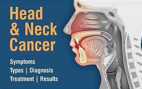 Image result for Head and Neck Cancer Symptoms