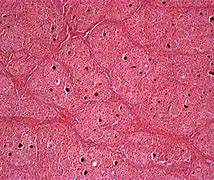 Image result for carcinoma_hepatocellulare