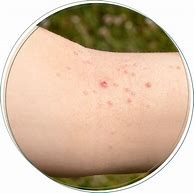 Image result for Viral Skin Infections Molluscum Contagiosum