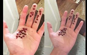 Image result for Trypophobia On Hand