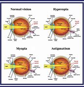 Image result for Multifocal Contact Lenses Double Vision