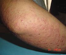 Image result for Severe Keratosis Pilaris