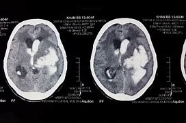 Image result for Intracerebral Hemorrhage CT