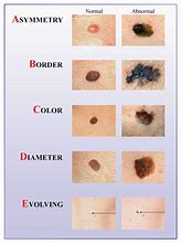 Image result for Melanoma Skin Cancer with Tag