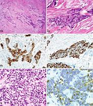 Image result for Small Cell Osteosarcoma