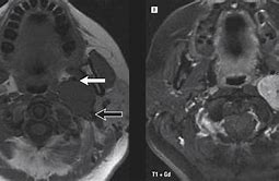 Image result for Schwannoma Tumor Neck