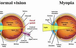 Image result for Congenital Myopia