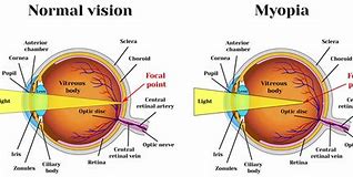 Image result for Myopia Template