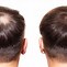 Image result for Minoxidil Aging