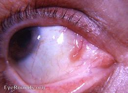 Image result for Conjunctival Papilloma Removal