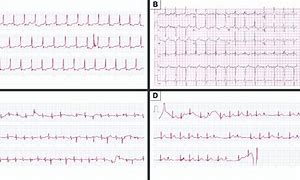 Image result for Apple Watch ECG Examples