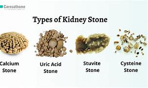 Image result for 1.4 Cm Kidney Stone