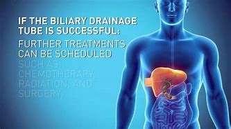 Image result for Biliary Drainage