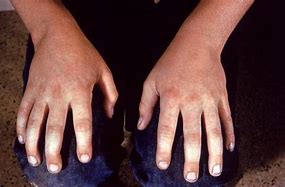 Image result for Fifth Disease Rash On Hands