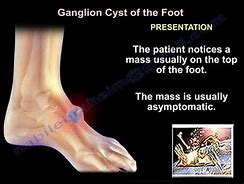 Image result for Midfoot Ganglion Cyst