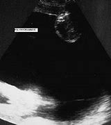 Image result for Polyhydramnios Ultrasound