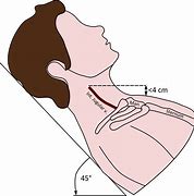 Image result for Measuring Jvd with Ruler