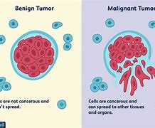 Image result for How Big Is a 2 5 Cm Tumor