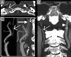Image result for CT Carotid Angiogram