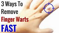 Image result for How to Remove Warts On Hands