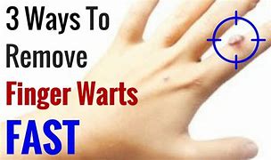 Image result for Warts On Hands Treatment