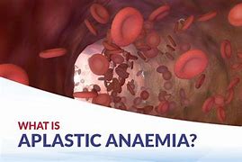 Image result for Aplastic Anemia